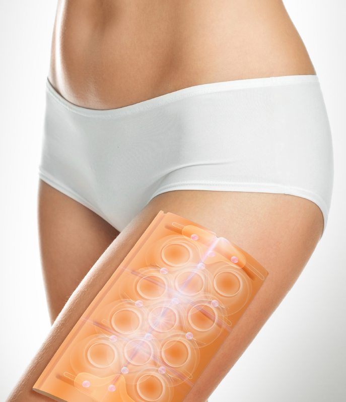 Cellulite treatment